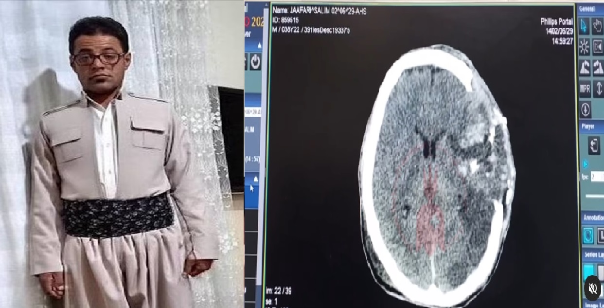 Volunteer doctors of Kurdistan published pictures of Fardin Jafari's brain injury