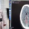 Volunteer doctors of Kurdistan published pictures of Fardin Jafari's brain injury